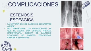 COMPLICACIONES
• LA MAYORIA DE LOS CASOS ES SECUNDARIO
A ERGE.
• MUY IMPORTANTE LOS ANTECEDENTES YA
QUE SE ASOCIA CON CIRUGÍAS PREVIAS,
RADIOTERAPIA, INGESTA DE CAUTICOS,
LIGADURAS DE VARICES ESOFAGICAS,
CANCER Y ESOFAGITIS
ESTENOSIS
ESOFAGICA
 
