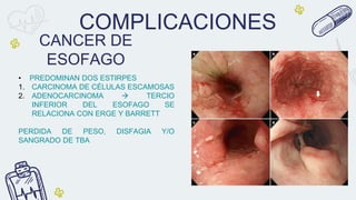 COMPLICACIONES
• PREDOMINAN DOS ESTIRPES
1. CARCINOMA DE CÉLULAS ESCAMOSAS
2. ADENOCARCINOMA  TERCIO
INFERIOR DEL ESOFAGO SE
RELACIONA CON ERGE Y BARRETT
PERDIDA DE PESO, DISFAGIA Y/O
SANGRADO DE TBA
CANCER DE
ESOFAGO
 