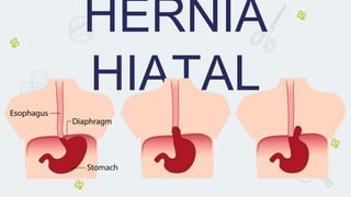 HERNIA
HIATAL
 