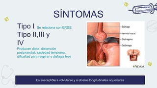 SÍNTOMAS
Tipo I Se relaciona con ERGE
Tipo II,III y
IV
Producen dolor, distención
postprandial, saciedad temprana,
dificultad para respirar y disfagia leve
Es susceptible a volvularse y a úlceras longitudinales isquemicas
 