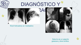 DIAGNÓSTICO Y
VALORACIÓN
Saturno es un gigante
gaseoso y tiene anillos
Nivel hidroaéreo en mediastino
 
