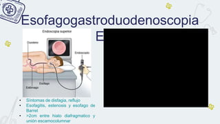 Esofagogastroduodenoscopia
EGD
• Síntomas de disfagia, reflujo
• Esofagitis, estenosis y esofago de
Barret
• >2cm entre hiato diafragmatico y
unión escamocolumnar
 
