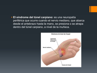  El síndrome del túnel carpiano: es una neuropatía
periférica que ocurre cuando el nervio mediano, que abarca
desde el antebrazo hasta la mano, se presiona o se atrapa
dentro del túnel carpiano, a nivel de la muñeca.
 