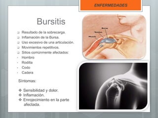 Bursitis
 Resultado de la sobrecarga.
 Inflamación de la Bursa.
 Uso excesivo de una articulación.
 Movimientos repetitivos.
 Sitios comúnmente afectados:
• Hombro
• Rodilla
• Codo
• Cadera
ENFERMEDADES
Síntomas:
 Sensibilidad y dolor.
 Inflamación.
 Enrojecimiento en la parte
afectada.
 