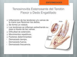 Tenosinovitis Estenosante del Tendón
Flexor o Dedo Engatillado
 Inflamación de los tendones y/o vainas de
la mano que flexionan los dedos.
 Se forma un nódulo.
 Los tendones se inflaman estrechando su
paso a través de las vainas.
 Dificultad de extensión.
 Movimientos repetitivos.
 Factores determinantes:
• Demasiado tiempo.
• Demasiada fuerza.
• Demasiada frecuencia.
ENFERMEDADES
 
