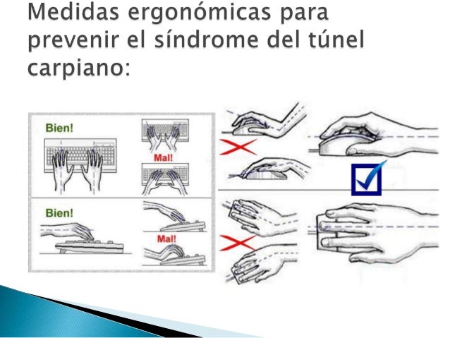 Ergonomía y síndrome del túnel carpiano (stc Ergonomía y síndrome del túnel carpiano (stc