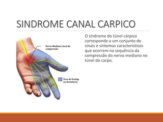 SINDROME CANAL CARPICO
O síndrome do túnel cárpico
corresponde a um conjunto de
sinais e sintomas característicos
que ocorrem na sequência da
compressão do nervo mediano no
túnel do carpo.
 