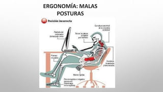 ERGONOMÍA: MALAS
POSTURAS
 