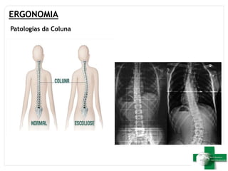 ERGONOMIA
Patologias da Coluna
 