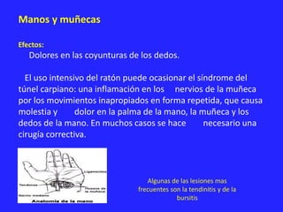 Manos y muñecas
Efectos:
Dolores en las coyunturas de los dedos.
El uso intensivo del ratón puede ocasionar el síndrome del
túnel carpiano: una inflamación en los nervios de la muñeca
por los movimientos inapropiados en forma repetida, que causa
molestia y dolor en la palma de la mano, la muñeca y los
dedos de la mano. En muchos casos se hace necesario una
cirugía correctiva.
Algunas de las lesiones mas
frecuentes son la tendinitis y de la
bursitis
 