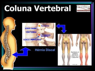Coluna Vertebral Hérnia Discal 
