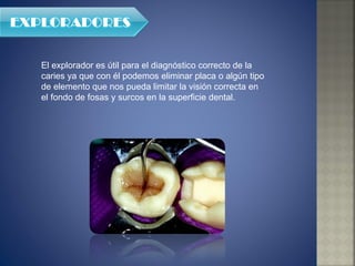 El explorador es útil para el diagnóstico correcto de la caries ya que con él podemos eliminar placa o algún tipo de elemento que nos pueda limitar la visión correcta en el fondo de fosas y surcos en la superficie dental. 