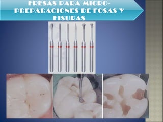 FRESAS PARA MICRO-PREPARACIONES DE FOSAS Y FISURAS 