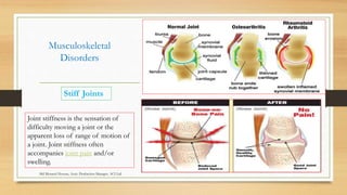 Musculoskeletal
Disorders
Stiff Joints
Joint stiffness is the sensation of
difficulty moving a joint or the
apparent loss of range of motion of
a joint. Joint stiffness often
accompanies joint pain and/or
swelling.
Md Mosaruf Hossan, Asstt. Production Manager, ACI Ltd.
 