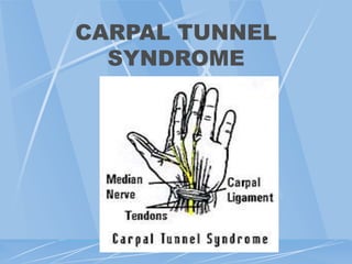 CARPAL TUNNEL
SYNDROME
 