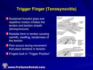 Trigger Finger Node Ergonomics For Dental Hygienists | PPT