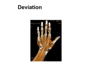 Wrist Deviation and Tendons
 
