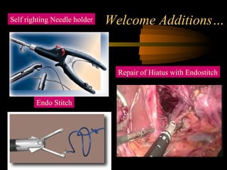 Welcome Additions…
Endo Stitch
Self righting Needle holder
Repair of Hiatus with Endostitch
 