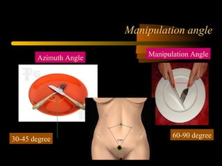 Manipulation angle
Azimuth Angle
Manipulation Angle
30-45 degree
60-90 degree
 