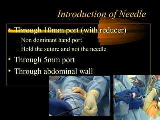 Introduction of Needle
• Through 10mm port (with reducer)
– Non dominant hand port
– Hold the suture and not the needle
• Through 5mm port
• Through abdominal wall
 