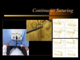 Continuous Suturing
 