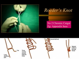 Roeder’s Knot
No 2 Chromic Catgut
Eg: Appendix base
 