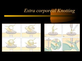 Extra corporeal Knotting
 