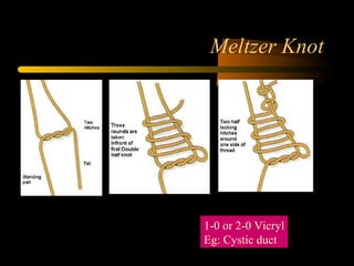 Meltzer Knot
1-0 or 2-0 Vicryl
Eg: Cystic duct
 