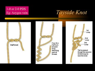 Tayside Knot
1-0 or 2-0 PDS
Eg: Azygos vein
 