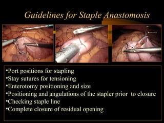 Guidelines for Staple Anastomosis
•Port positions for stapling
•Stay sutures for tensioning
•Enterotomy positioning and size
•Positioning and angulations of the stapler prior to closure
•Checking staple line
•Complete closure of residual opening
 