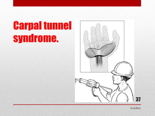 Carpal tunnel
syndrome.

37
11/6/2013

 