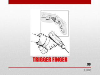 TRIGGER FINGER

38
11/6/2013

 