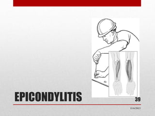 EPICONDYLITIS

39
11/6/2013

 