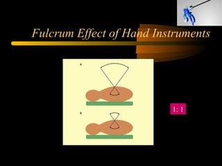 Fulcrum Effect of Hand Instruments
1: 1
 