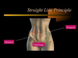 Straight Line Principle
Surgeon
Pathology
Monitor
 