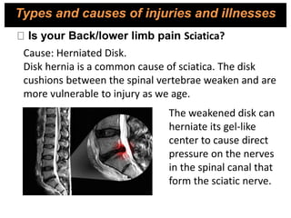 Is your Back/lower limb pain Sciatica?
Cause: Herniated Disk.
Disk hernia is a common cause of sciatica. The disk
cushions between the spinal vertebrae weaken and are
more vulnerable to injury as we age.
The weakened disk can
herniate its gel-like
center to cause direct
pressure on the nerves
in the spinal canal that
form the sciatic nerve.
Types and causes of injuries and illnesses
 