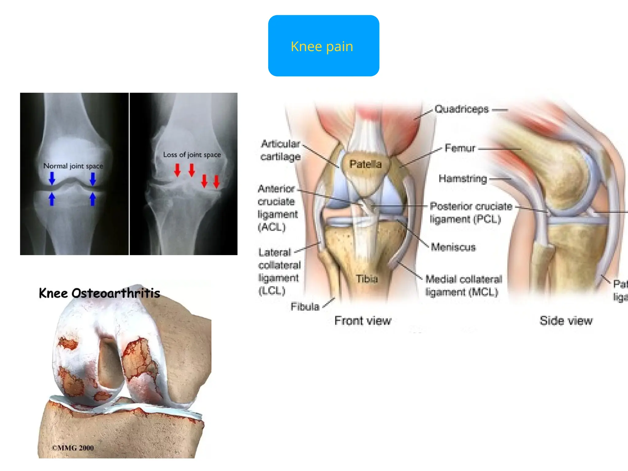 Knee pain
 