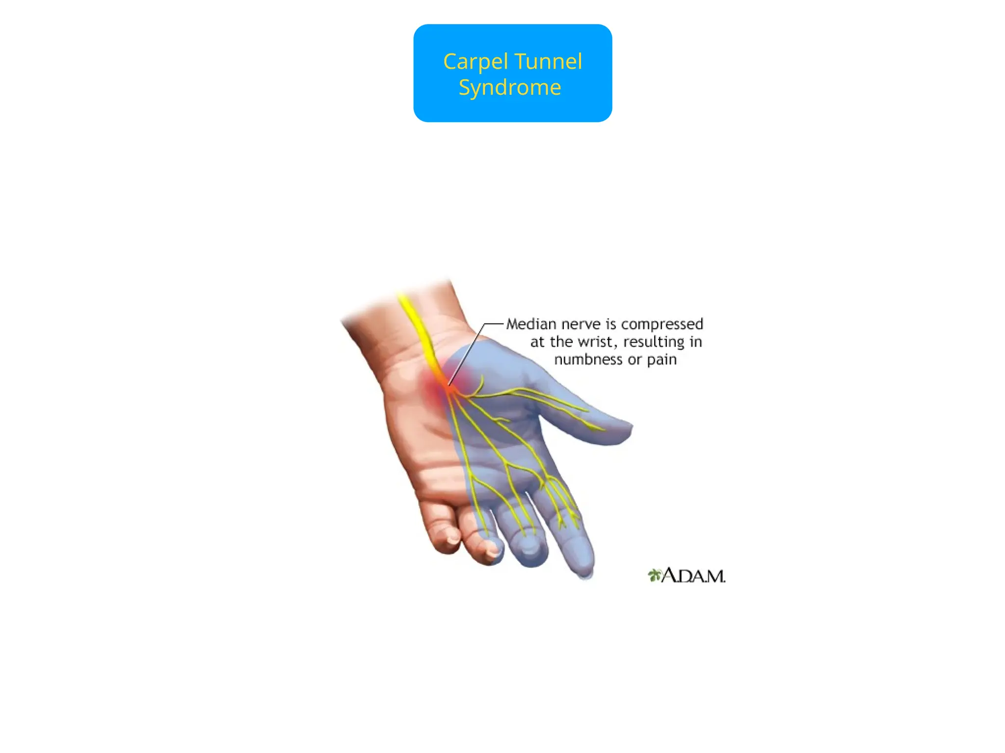 Carpel Tunnel
Syndrome
 