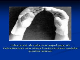 Orthèse de travail : elle stabilise et met au repos le poignet et la
trapézométacarpienne tout en autorisant les gestes professionnels sans douleur
(polyarthrite rhumatoïde)
 