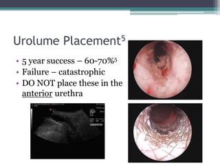 Urolume Placement5
• 5 year success – 60-70%5
• Failure – catastrophic
• DO NOT place these in the
anterior urethra
 