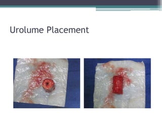 Urolume Placement
 