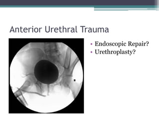 Anterior Urethral Trauma
• Endoscopic Repair?
• Urethroplasty?
 