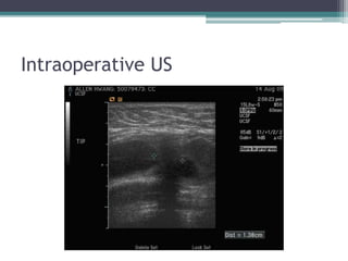 Intraoperative US
 