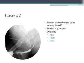Case #2
• Lumen size estimated to be
around 8-10 F
• Length – 3 to 4 cm
• Options?
▫ EPA
▫ Graft
▫ Flap
 