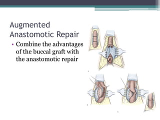 Augmented
Anastomotic Repair
• Combine the advantages
of the buccal graft with
the anastomotic repair
 