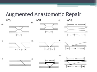 Augmented Anastomotic Repair
EPA AAR AAR
 