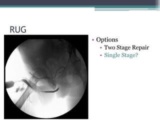 RUG
• Options
• Two Stage Repair
• Single Stage?
 
