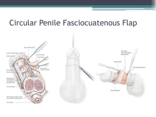 Circular Penile Fasciocuatenous Flap
 