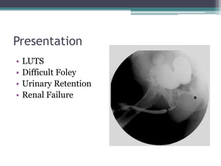 Presentation
• LUTS
• Difficult Foley
• Urinary Retention
• Renal Failure
 