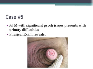 Case #5
• 35 M with significant psych issues presents with
urinary difficulties
• Physical Exam reveals:
 